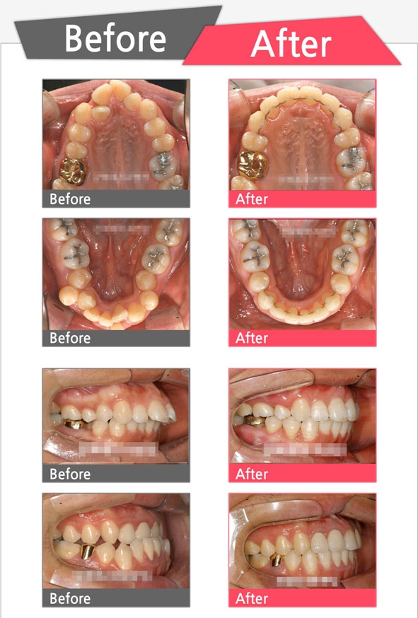 치아교정전,후사진.jpg
